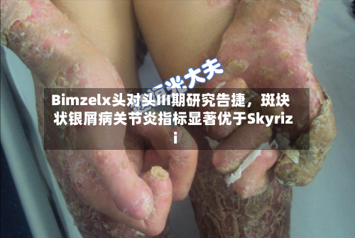 Bimzelx头对头III期研究告捷，斑块状银屑病关节炎指标显著优于Skyrizi